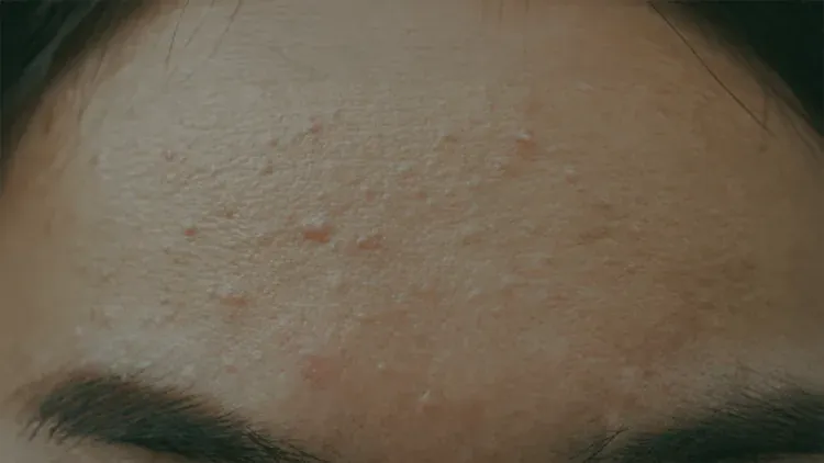Fungal akne, klasik sivilce tedavileriyle geçmeyen, genellikle sırt, göğüs ve yüzde yoğunlaşan kaşıntılı döküntülerle kendini gösteren bir cilt problemidir. Görünüşte akneye benzese de, kaynağı bakteriyel değil mantarsaldır ve bu nedenle yanlış tedavi uygulandığında daha da kötüleşebilir. Özellikle yağ bazlı kozmetikler, aşırı terleme ve nemli ortamlar bu durumu tetikleyebilir. Fungal akne tedavisi, bu farklılığı dikkate alarak antifungal içerikli ürünlerle yapılmalıdır.