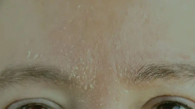 Ölü Deri Nedir? Yüzdeki ve Vücuttaki Ölü Deri Nasıl Temizlenir?